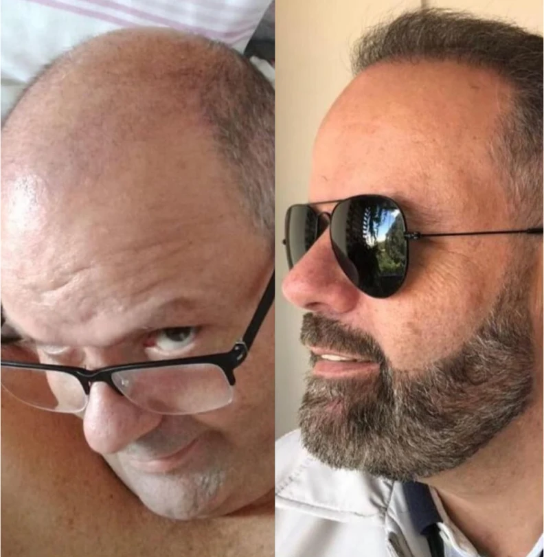 Comparación antes y después de trasplante capilar masculino, paciente 6, calvicie avanzada recuperada con nueva línea capilar natural, fotografía clínica realista