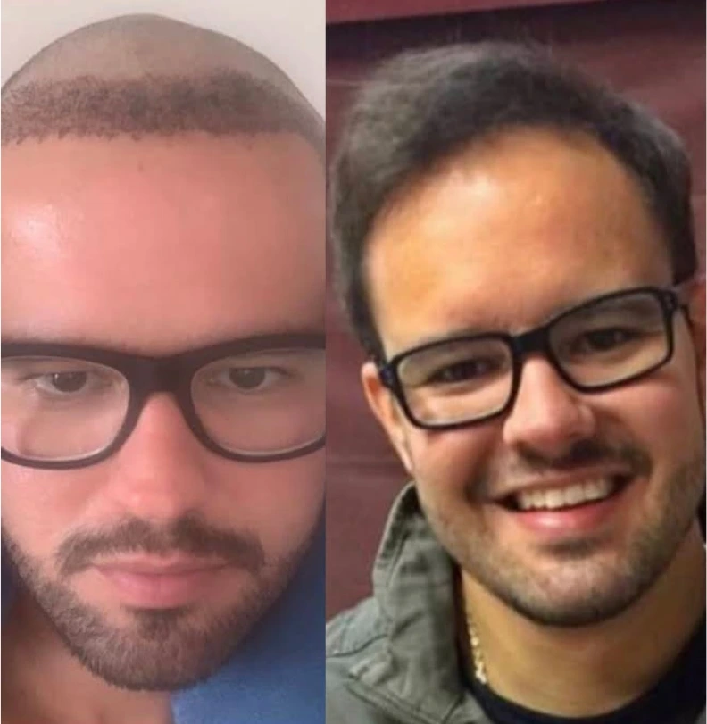 Comparación antes y después de trasplante capilar masculino, paciente 4, cuero cabelludo rapado recuperado con cabello corto denso y uniforme, fotografía clínica realista