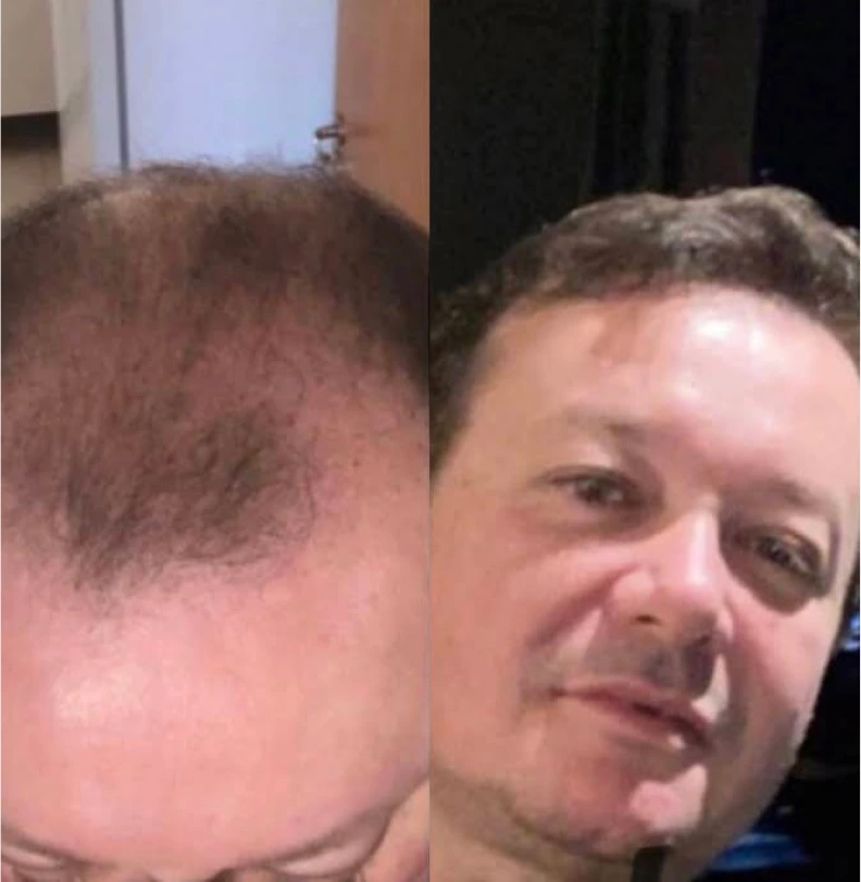 Comparación antes y después de trasplante capilar masculino, paciente 1, entradas acentuadas recuperadas con cabello denso en la línea frontal, resultado natural, fotografía clínica realista