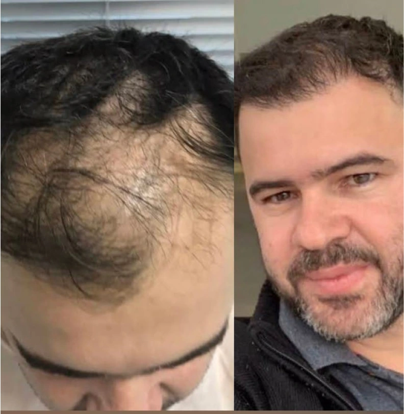 Comparación antes y después de trasplante capilar masculino, paciente 3, línea frontal recuperada con densidad natural, fotografía clínica realista