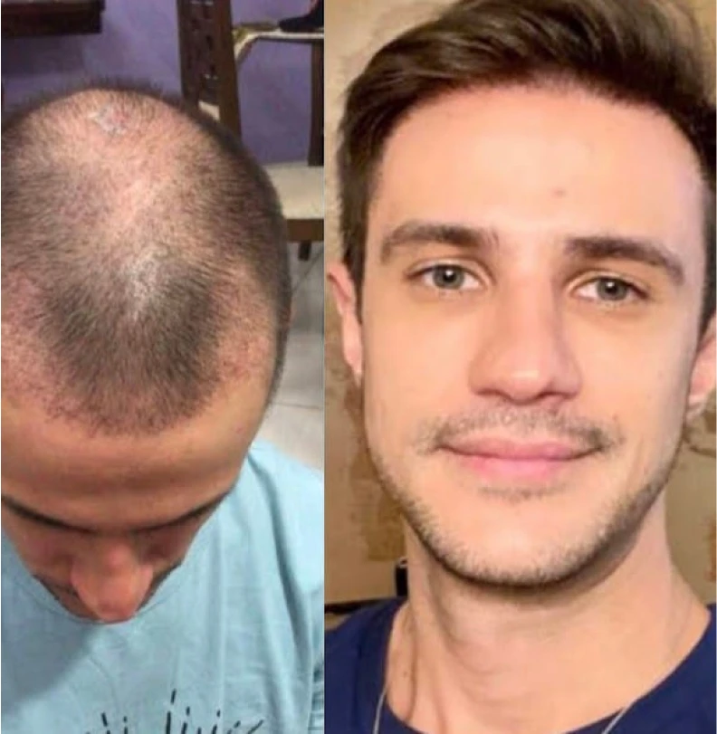 Comparación antes y después de trasplante capilar masculino, paciente 2, coronilla con calvas recuperada con cabello lleno y natural, fotografía clínica realista