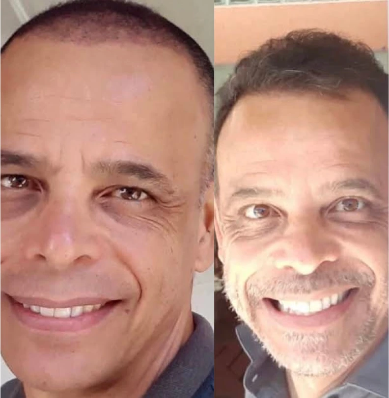 Comparación antes y después de trasplante capilar masculino, paciente 5, entradas y coronilla recuperadas con cabello canoso natural, fotografía clínica realista